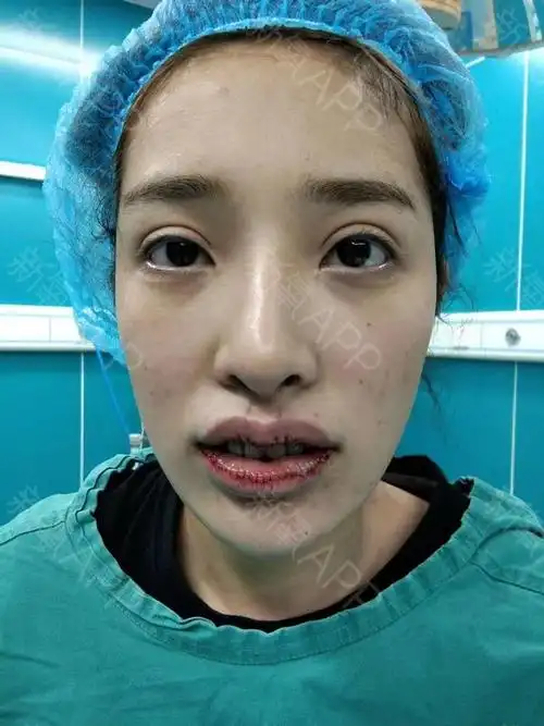 上下唇改薄 上唇m术后当天的效果,本来只做上下唇改_圈子-新氧美容