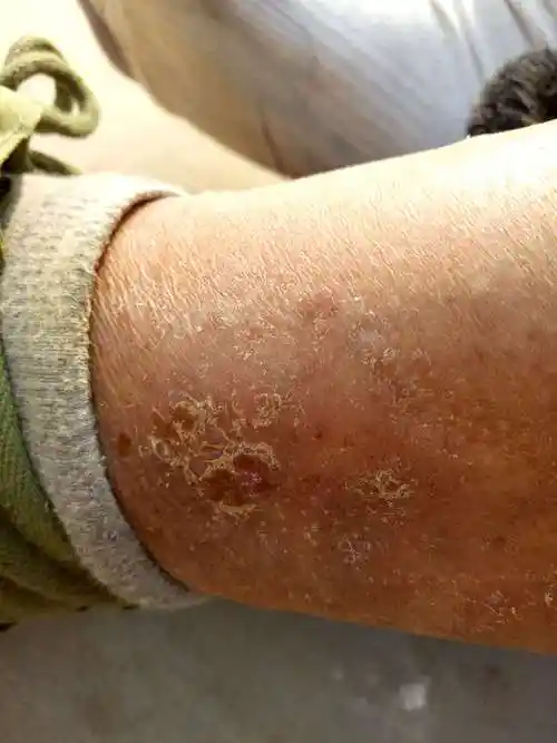 医生你好左腿脚踝上方长了一块癣一样的东西会像疤一样往下掉