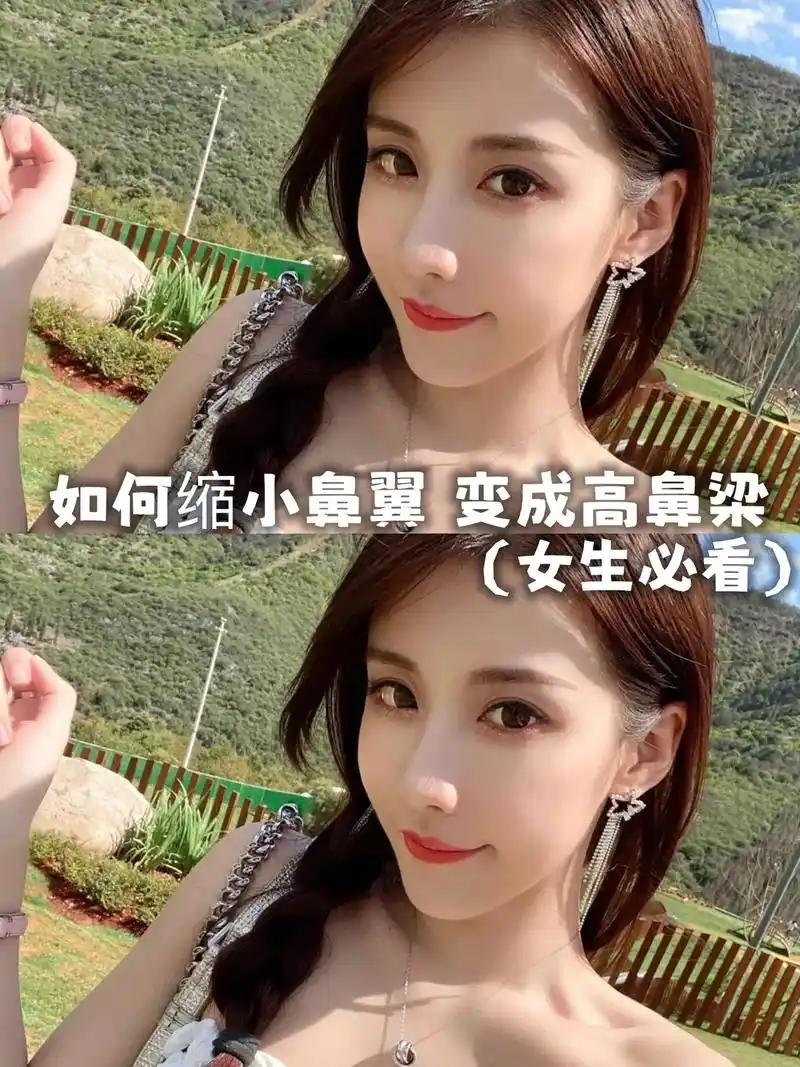 如何缩小鼻翼 变成高鼻梁.