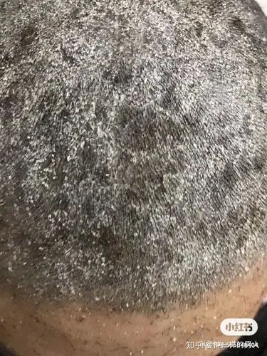 头皮牛皮廯头皮屑头皮痒困扰很多年了头皮牛皮廯头皮屑头皮痒头皮藓病