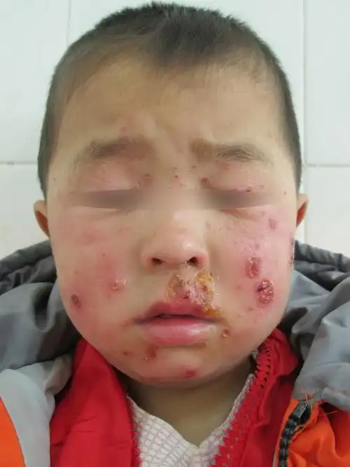 脓疱疮诊断治疗一种儿童好发的皮肤病