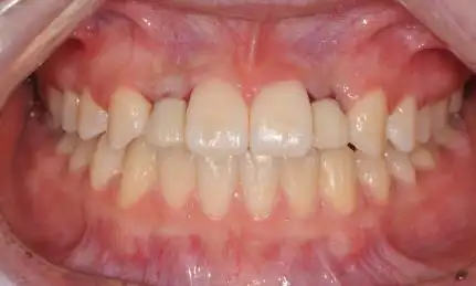 上颌侧切牙缺失