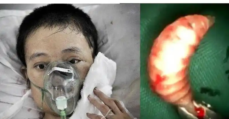 觉得我活不成了,我将死去」22岁女孩脸部溃烂,医生竟取出两百多条蛆虫