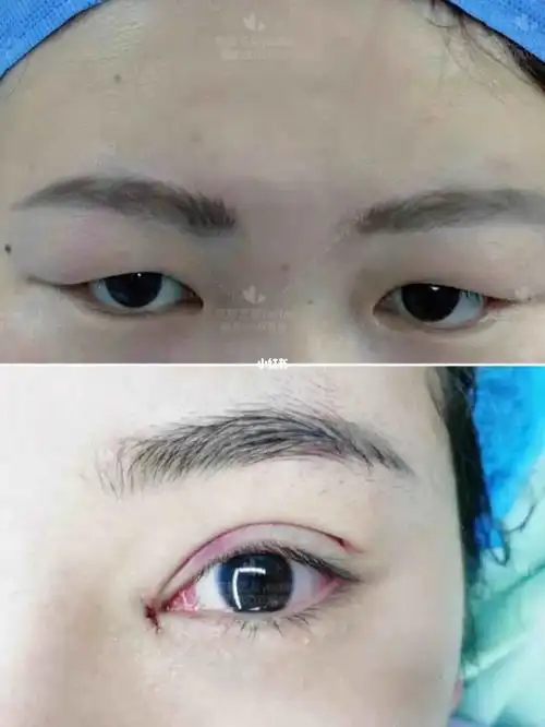 分享一个肿泡眼的术后即刻_肿眼泡_单眼皮_双眼皮_单眼皮肿眼泡_美妆