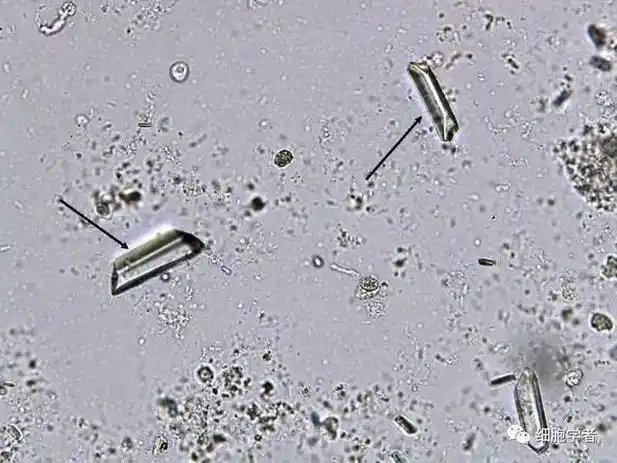 crystal 即三联磷酸盐结晶,属生理性结晶,正常情况可见,多见于碱性尿