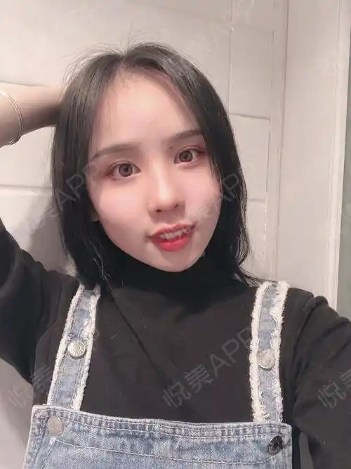 开内眼角术后151天_全切双眼皮术后151天_开眼角术后151天_双眼皮术后