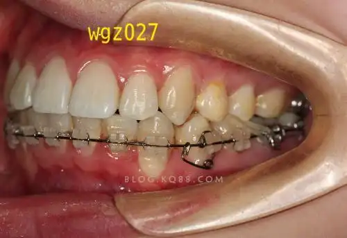 思考她的下颌尖牙如何排入牙列的原创