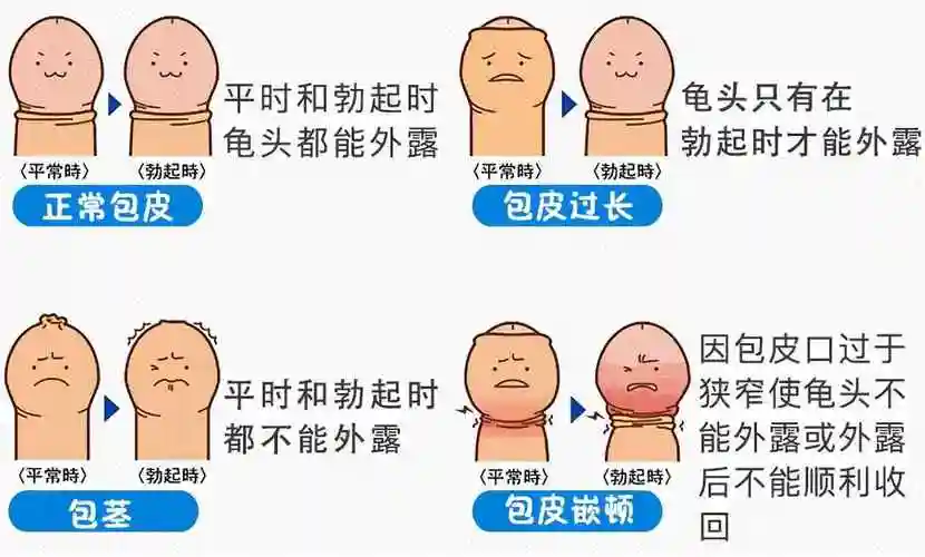 包皮是什么男孩包茎一定要割皮吗