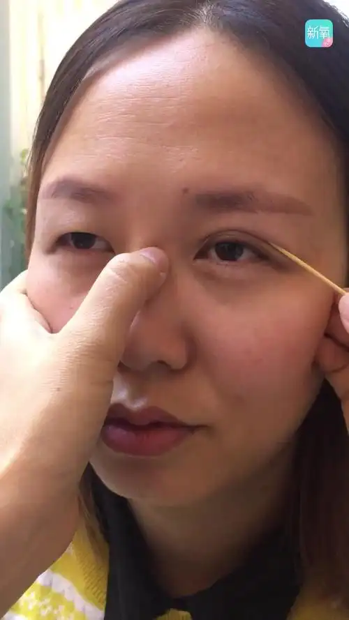 怎么判断真假性上睑下垂,看看你属不属于提肌无力 眼_圈子-新氧美容