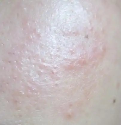 皮肤是过敏了吗?起了红斑,还很痒