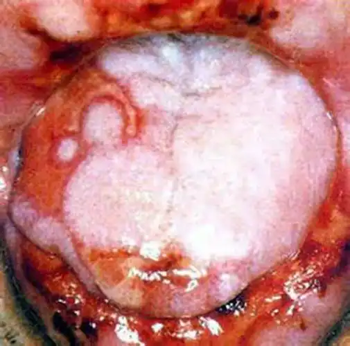 一期梅毒图片——肛门部硬下疳图片_有来医生