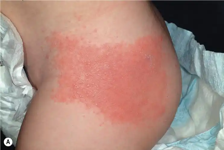 接触性皮炎的典型表现是边界清楚的红斑,水疱和(或)鳞屑性斑片或斑块