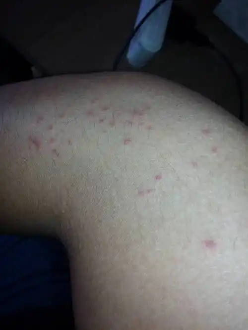 问:请问医生这是爱慈病前期长的红疹吗