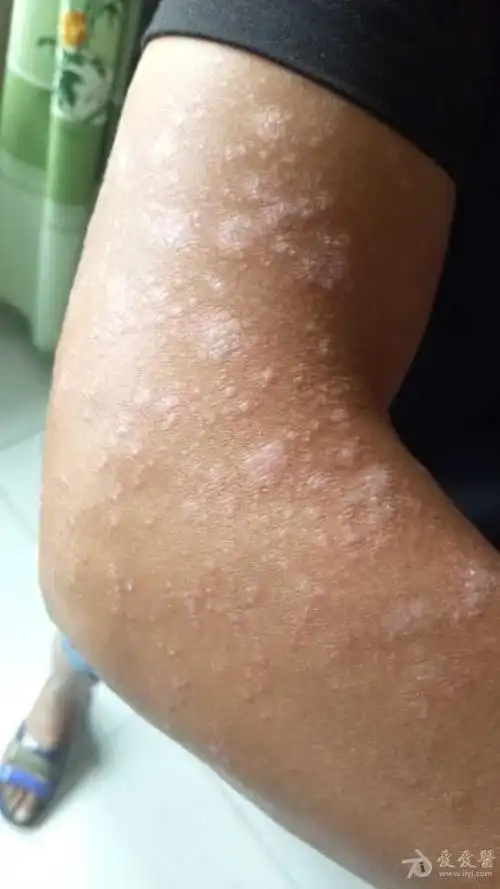 15年庆全科皮肤病看图诊疗一13多形性日光疹