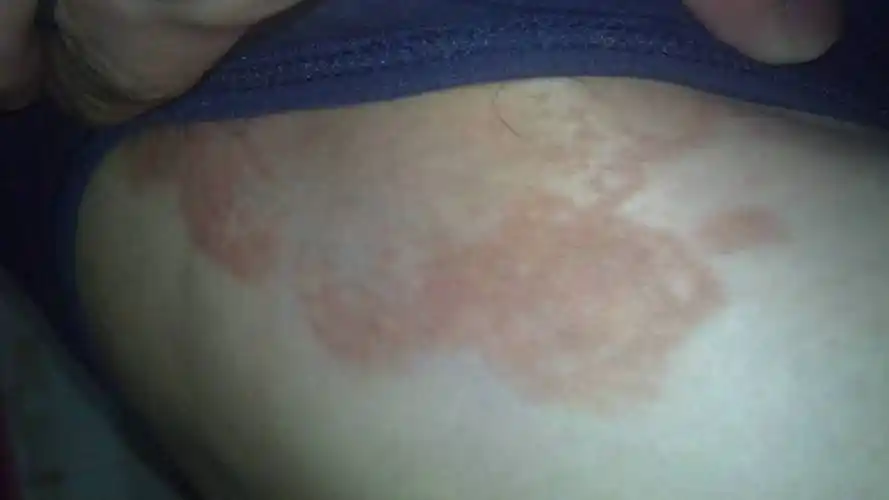 大腿内侧藓 (30)