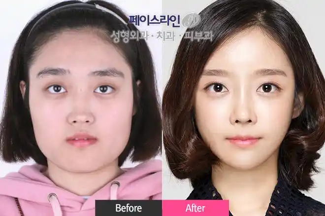 整容越来越普遍,怎么整才可以事半功倍变漂亮呢?