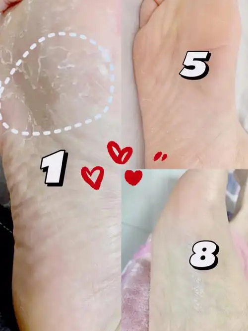 看到有说用醋来泡法子我都搞了搞,不仅没好,反而让我的脚酸臭混合大概