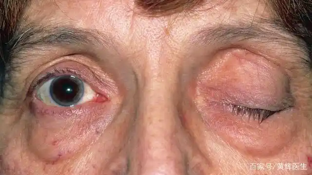 一侧眼睑下垂,可别当小事,有可能是重症肌无力的预兆!