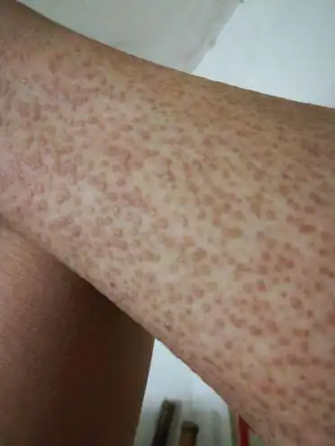 脚上长满密密麻麻的疙瘩是什么皮肤病_百度知道