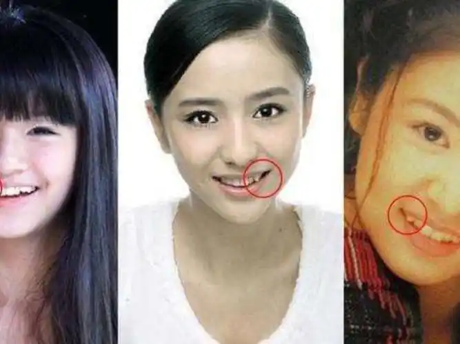 为什么虎牙最不能拔?