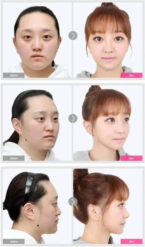 从疑夫症,肥胖妻子到美女妈妈,金真的手术前后对比照!