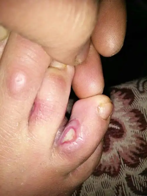 前二个月去医院看了说是烂脚丫但是狠多药都试过了没效果现在要怎么