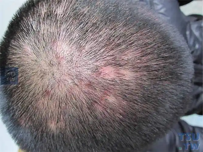 头顶部头发稀疏,散在毛囊性炎性丘疹