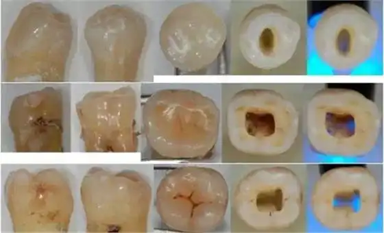 上颌中切牙, 侧切牙, 尖牙的开髓 最好在