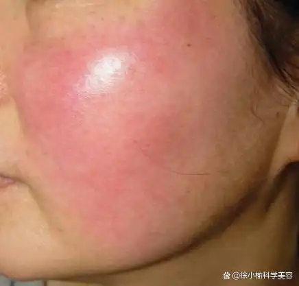 如果你的脸上有这种面部潮红要注意了!并不是简单的红血丝问题