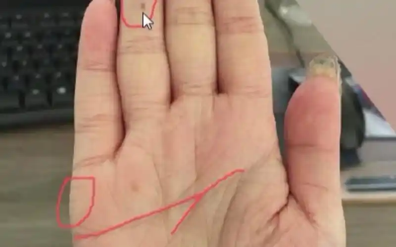 手相太阳丘有痣,代表什么?