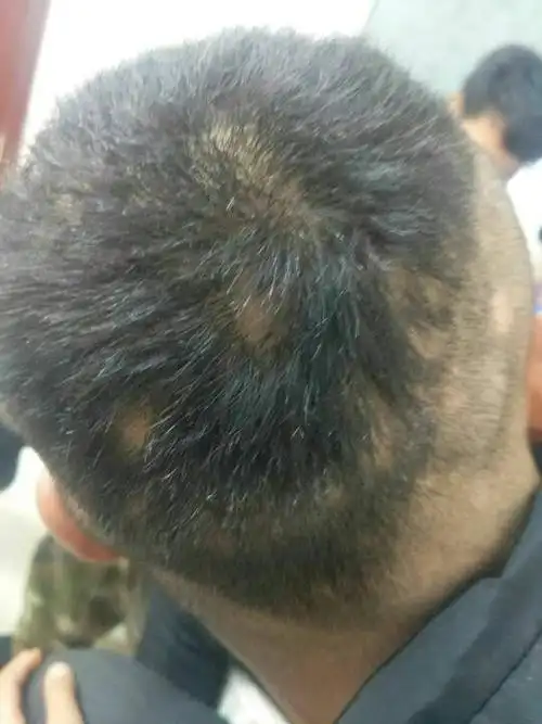 我朋友今年24,前段时间头发一块一块那样掉,他头发摸着很干硬,大家帮