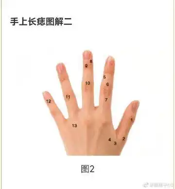 痣 67展开c痣在1:拇指第一节有痣者,多有父荫,有商事的能力,个性