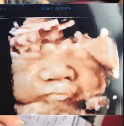 "看到四维彩超的时候,我整个人都不好了,孩子的嘴巴怎么了,这是我孩子