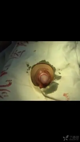 关于儿童包皮手术的方式和手法探讨