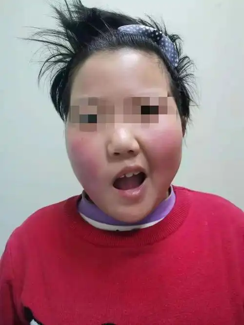 让笑容更加灿烂--面神经炎