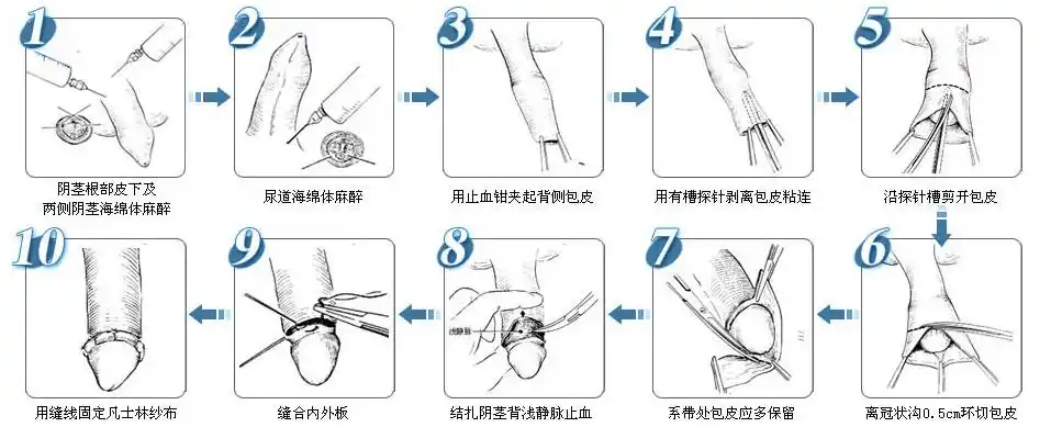 一次性包皮环切吻合器
