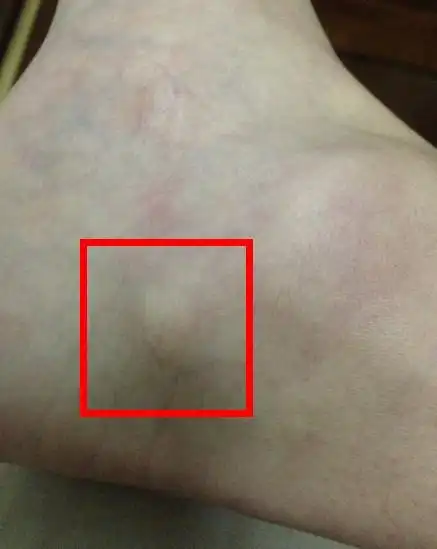 右脚脚掌的距骨位置,类似有一块软骨突出,用力按会痛,不知道怎么造成