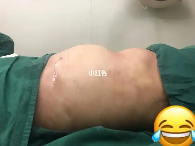 补个贴,之前做的吸脂失败经历分享下,四川做手术不管哪家医院都是个坑