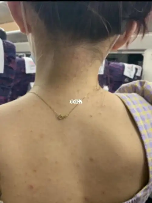 就算是不穿露背装,后背有毛囊炎还是很别扭呀_毛囊炎_药膏_沐浴露_露