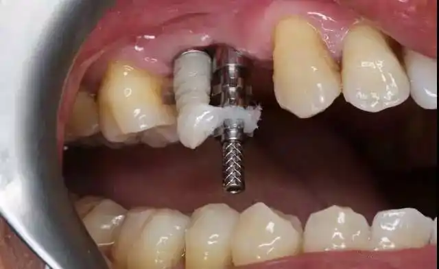 两颗种植牙种歪的病例补救