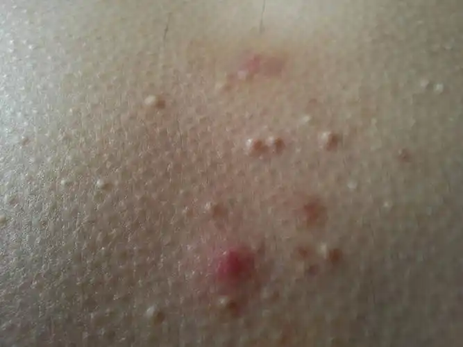 医师来自南京大学医院 答: 有没有丘疱疹,没有簇集状丘疱疹考虑毛囊炎