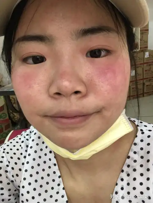 关于脸部皮肤病天知道我经历了什么