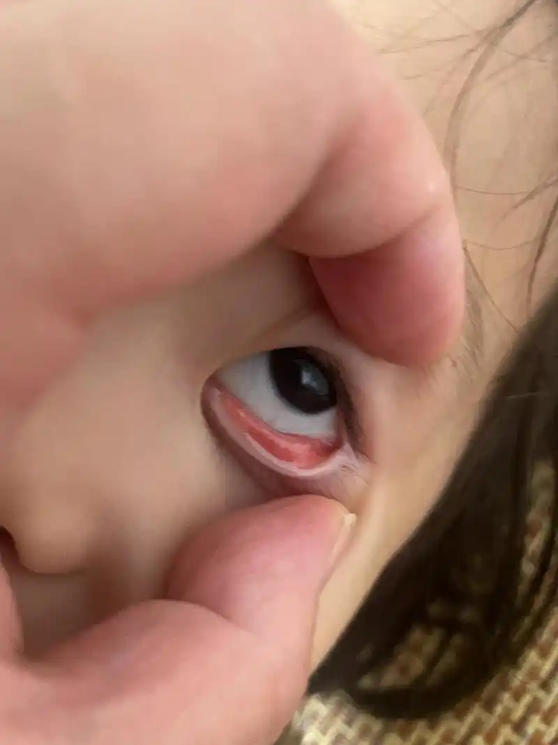 小孩下眼皮里面长很多一个个小水泡小疙瘩 是什么原因,眼睛还很红