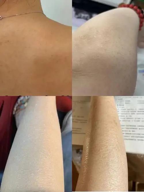 三甲皮肤科医生教你秋冬身体补水保湿办法,只要3步,做好秋冬身体护理!