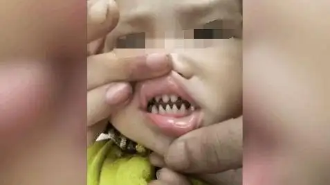 实拍宝宝这一副鲨鱼牙齿太有个性网友你儿子有贵族血统