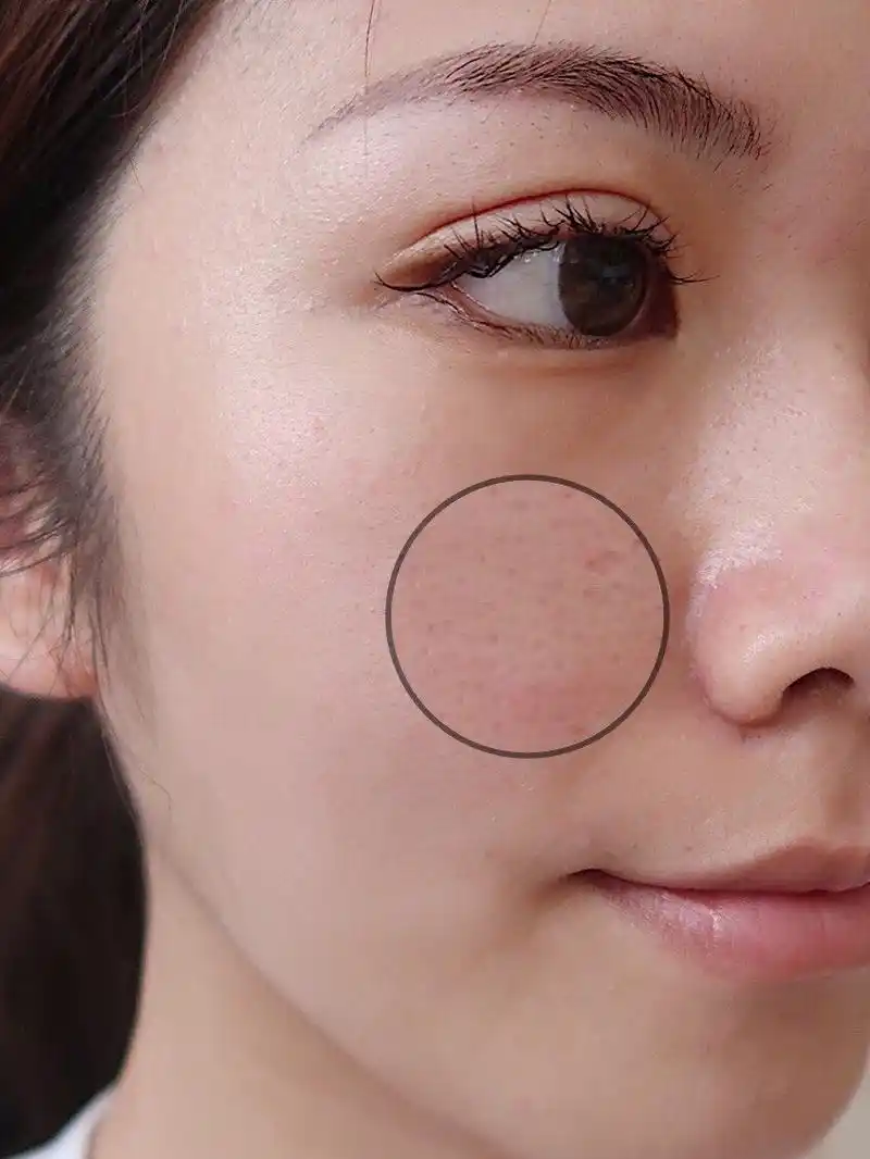 毛孔粗大确实很让人头疼 特别是约会的时候 毛孔这些小细节真的是连