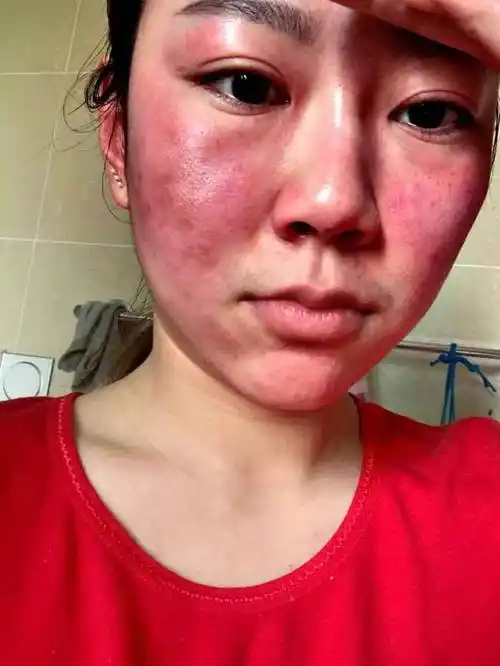 如何让脸部快速过敏(怎么让脸过敏又不伤皮肤)