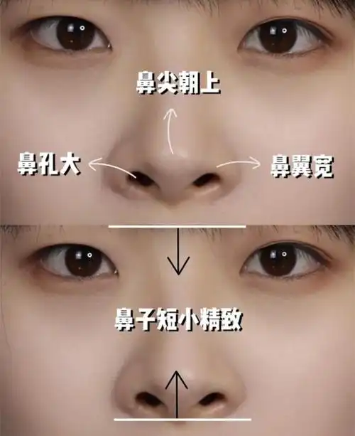 明明是同样的脸型和颜值,鼻子好不好看就成了关键.