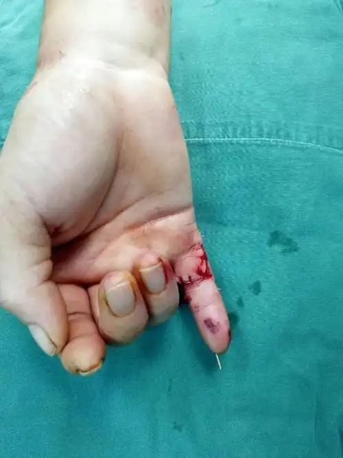 车床绞断手指患者不幸之后遇万幸