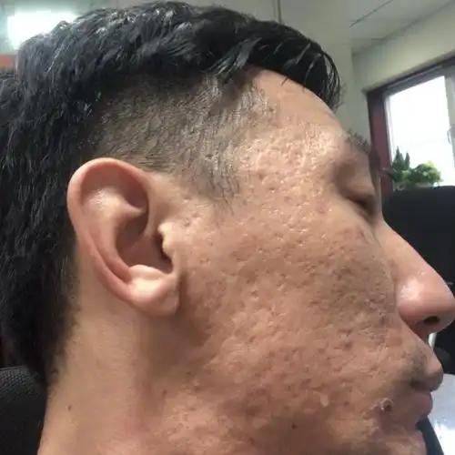 这么严重的痘坑还能治吗